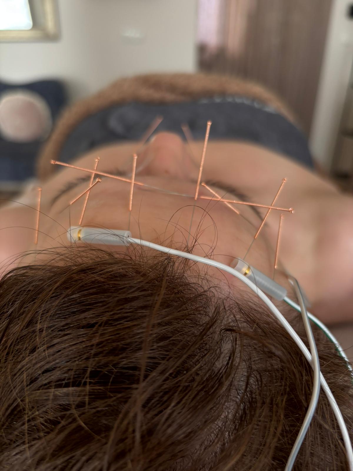 Neurolifting Elektroakupunkturowy — akupunktura estetyczna twarzy w Opolu, alternatywa dla botoksu